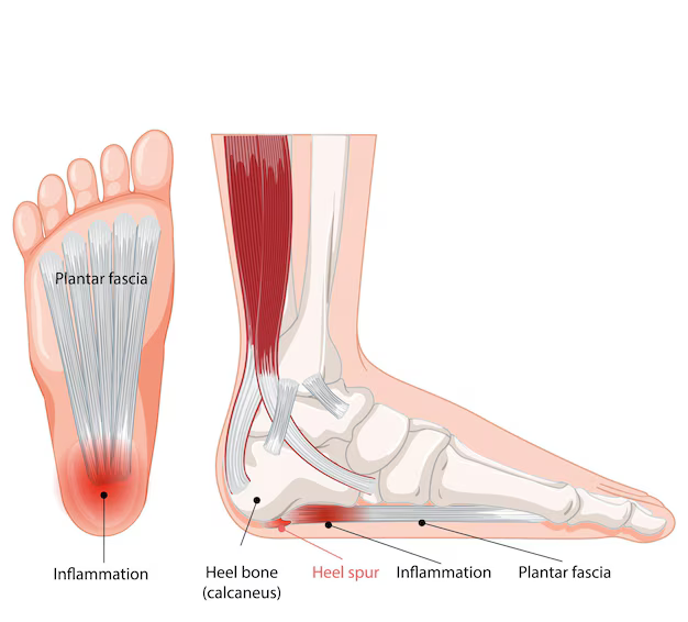 Morning Heel Pain: Is It Plantar Fasciitis or Something More?