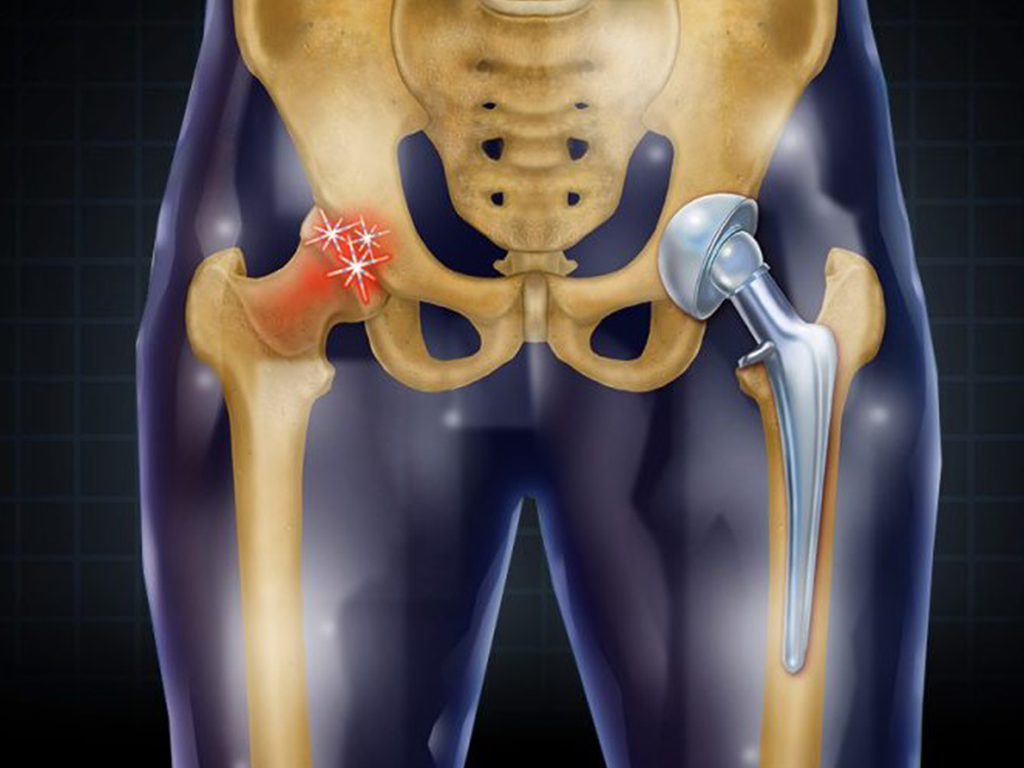 Hip Replacement: What You Need to Know