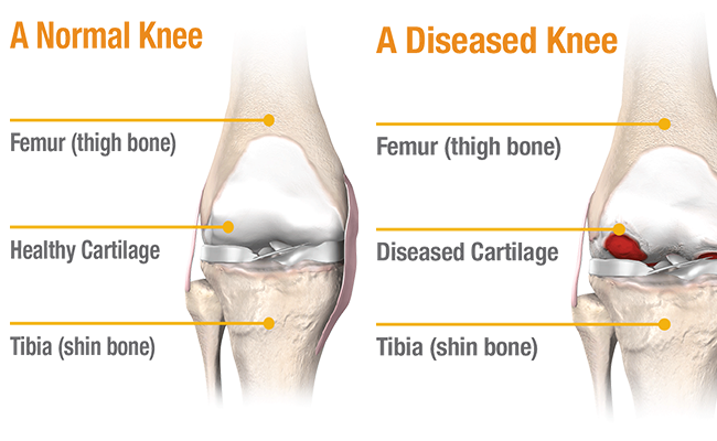 knee-a Dr Aman Dua explains about various treatment options for Knee Arthritis including non-operative methods and Knee Replacement Surgery