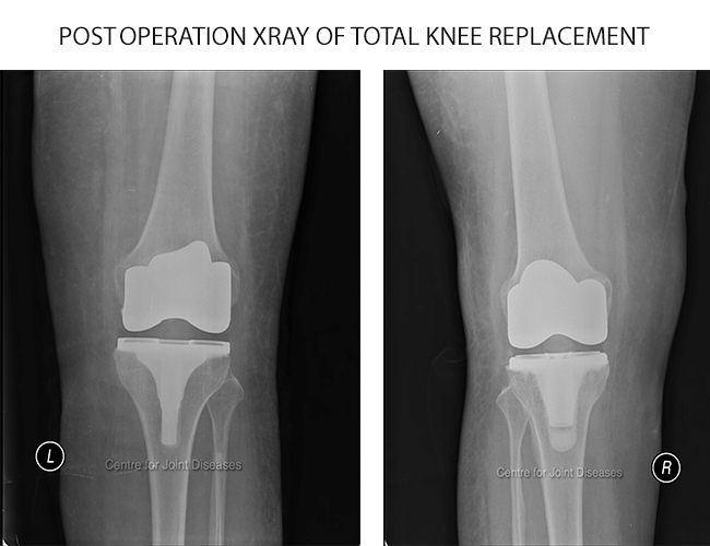 knee-replacement-a knee surgery specialist in delhi