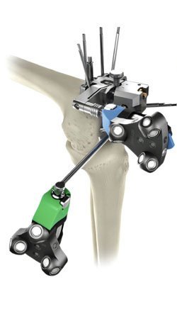 Computer Navigated Knee Replacement Surgery